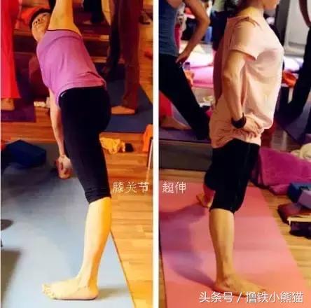 腿粗又有膝超伸该怎么改正,膝超伸为什么腿会粗