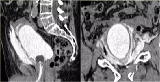 腹腔脏器炎症ct可以查出来吗,膀胱创伤的诊断方法
