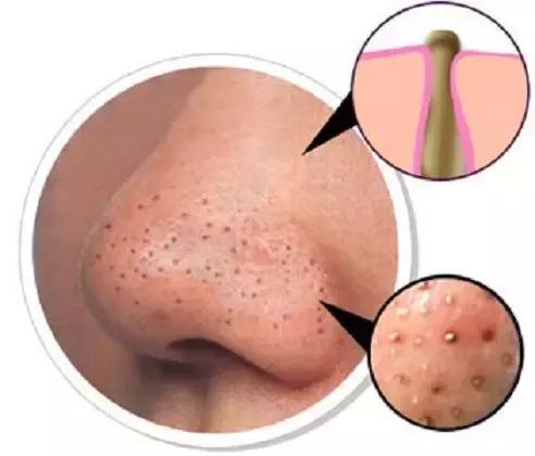 教你轻松消灭鼻头黑头,女童鼻子黑头出油怎么办