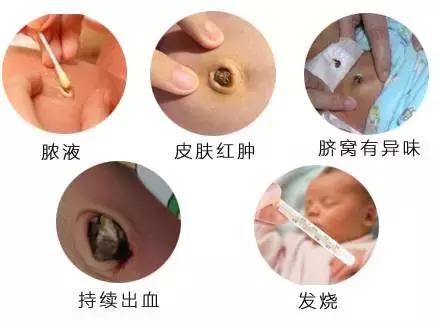 月嫂课堂练习新生儿脐带消毒,宝宝脐带护理月嫂处理