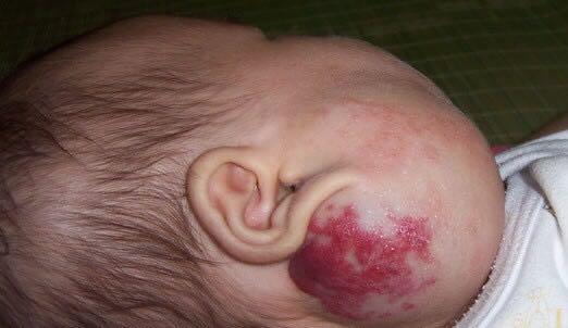 为鲜红斑痣患者发声，科大皮肤门诊部发起公益医疗援助活动