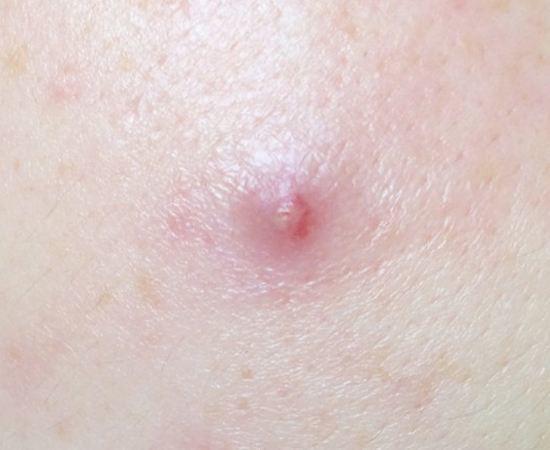 成人痘最佳治疗方法,成人痘痘不留疤痕祛除法