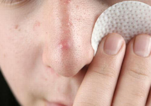 成人痘最佳治疗方法,成人痘痘不留疤痕祛除法