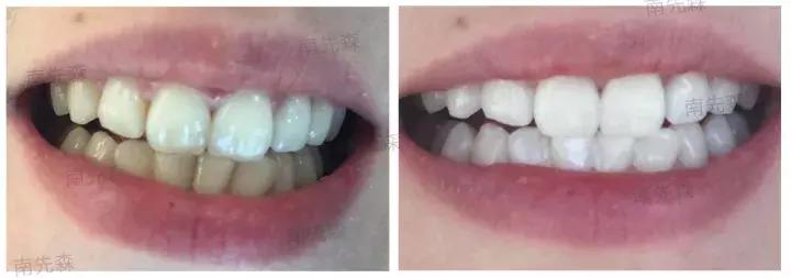 一周快速脸部美白小妙招,美容冠的形态怎么做的