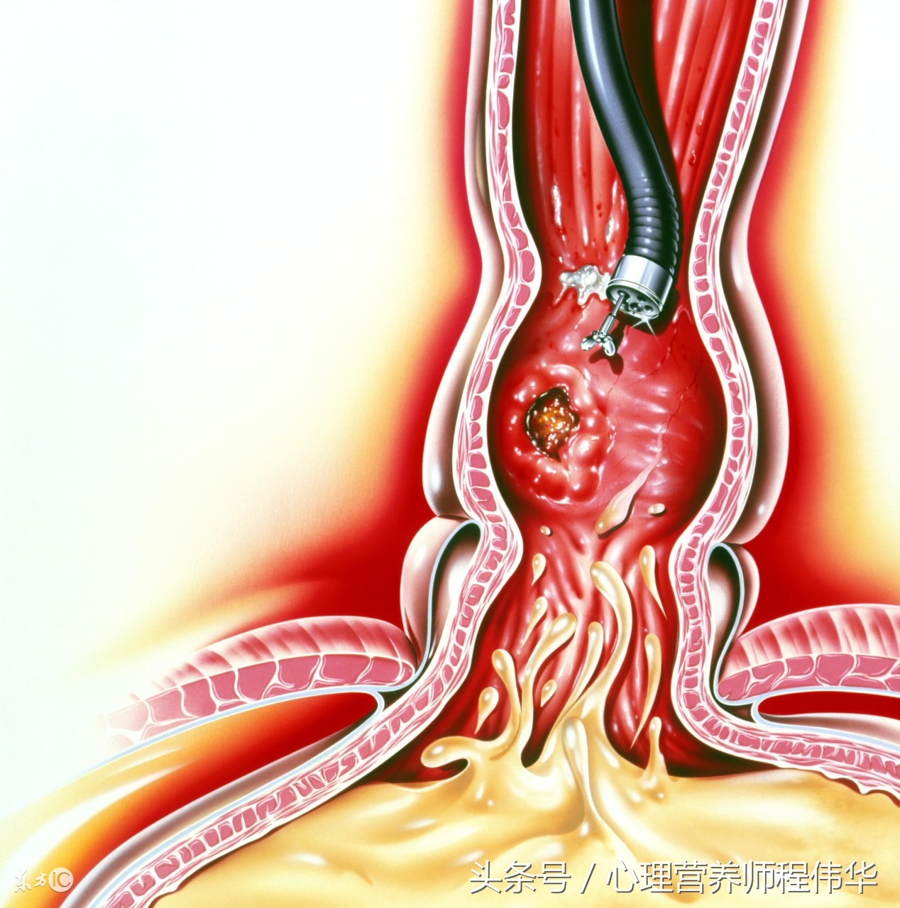 烧心的原因及解决办法,烧心的原因和治疗方法