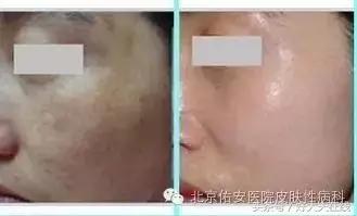 褐斑怎么治才能彻底消除,褐青色斑怎么治疗好