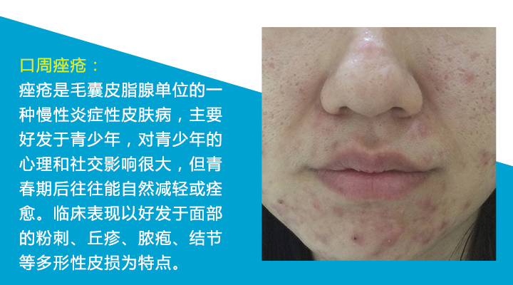 八种痘痘,九大部位的痘痘