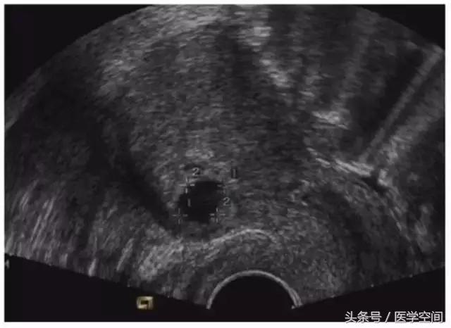 瘢痕妊娠的三维彩色超声图像,内生型瘢痕妊娠超声诊断标准