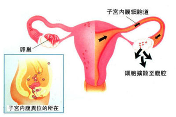 来例假之前胃出血怎么回事,女性经期异常出血