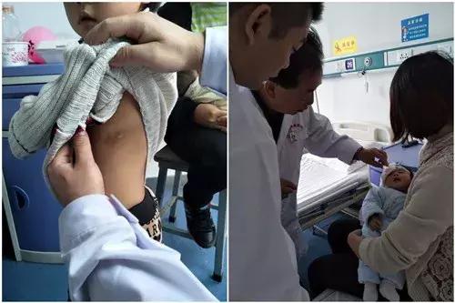 贵州最好血管瘤医院,贵阳长峰血管瘤医院