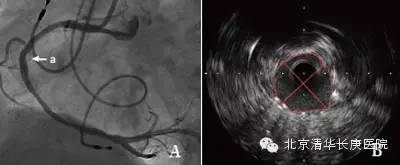 心血管超声技术,心血管超声最新技术