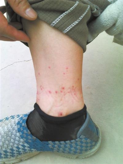 你的脚脖子出现过这种小红点吗?可知道它们是哪里来的