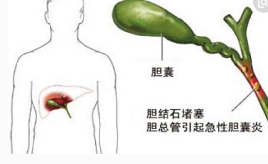 胆结石手术后食疗菜谱窍门大全,泥沙样胆结石食疗秘方10大排行榜