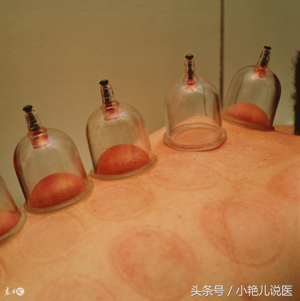 民间放血治病,放血有效吗