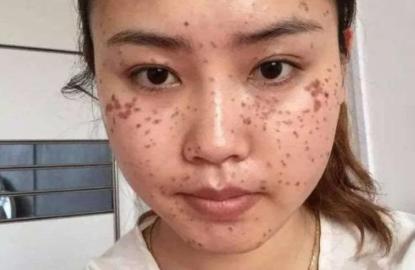 脸上的黄褐斑点怎么去除,脸上暗黄有斑怎么去掉啊