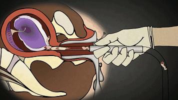 流产和宫外孕哪个可怕,流产跟怀孕有什么关系