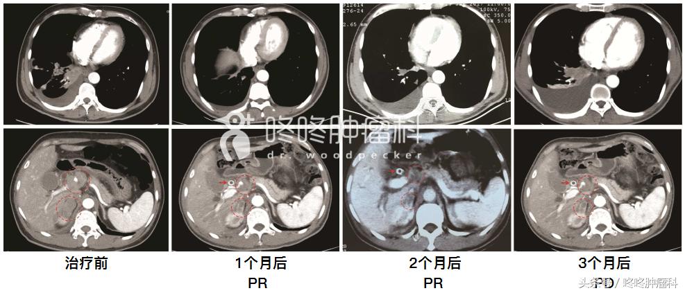 如何克服AZD9291的耐药，基因突变还分顺反？顺手教你破解之道