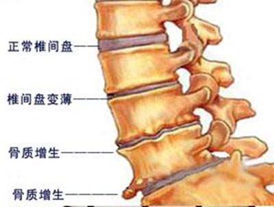 颈椎有增生怎么办,颈椎骨质增生是什么意思