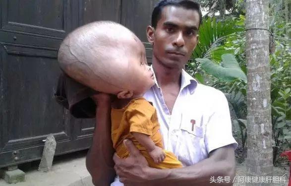 人血白蛋白可以治疗腿脚水肿吗,白蛋白对脑出血水肿有好处吗