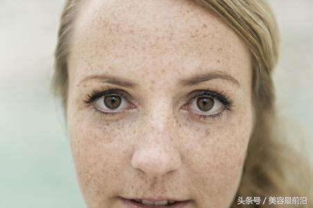 如何去掉脸上烦人的雀斑,怎么去除脸上的雀斑最快