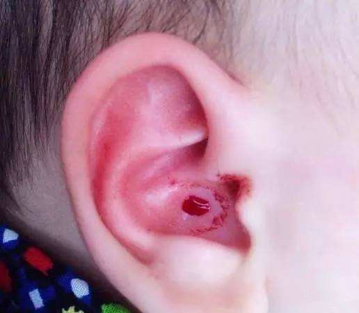 1月龄宝宝耳朵出血,宝宝耳朵出血痂几个月了还没好