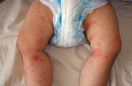 宝宝肤专家可以治疗湿疹吗,一岁半宝宝湿疹怎么治疗