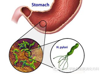 幽门螺杆菌用药可以喝酒吗,根治幽门螺杆菌的最新方法