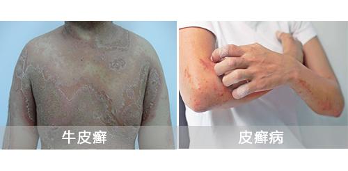 皮癣区分,皮癣和牛皮癣的区别