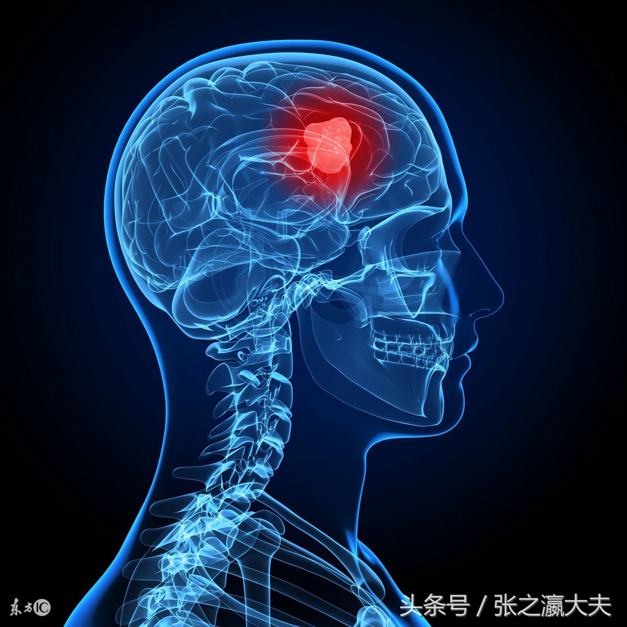 中老年要警惕脑梗塞要注意三点,老年人轻度脑梗塞的症状及治疗