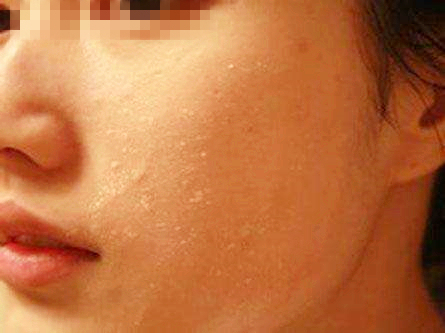 宝宝手起疹子皲裂,宝宝手长倒刺肿了怎么办