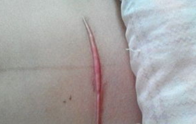 剖腹产后刀口发痒怎么回事,女人剖腹产两年疤痕痒痒