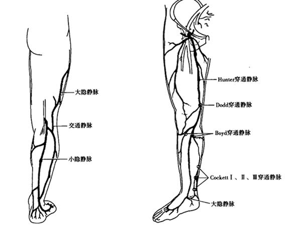腿部静脉曲张血液是怎么回流的,下肢静脉曲张并发症及处理方法