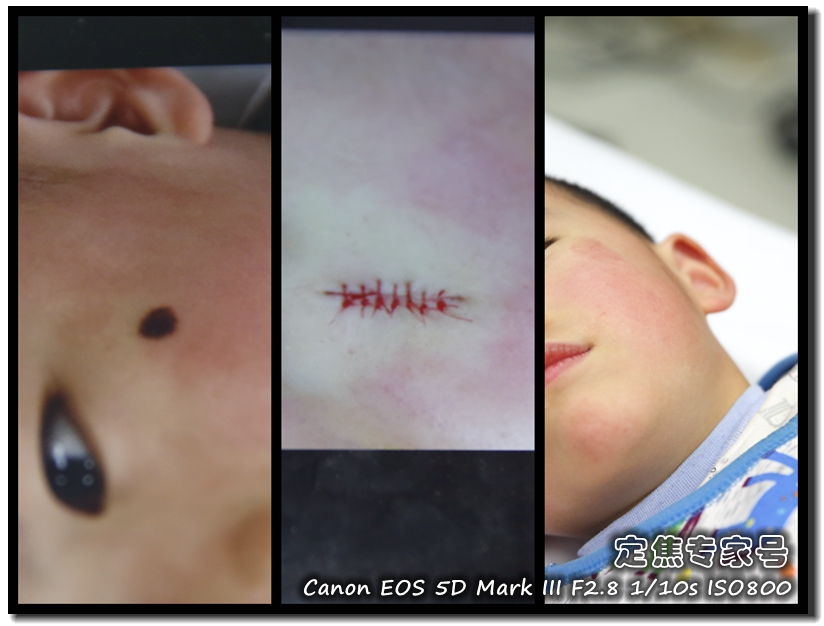 治疗头皮癣要多少钱,头皮上红斑为什么难治好