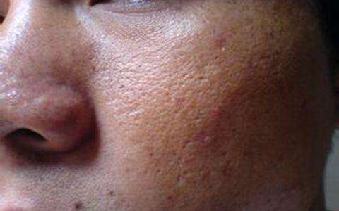 毛孔粗大做深层清洁能改善吗,毛孔粗大深层清洁用什么牌子面膜