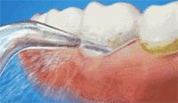 洗牙有什么副作用吗,洗牙怎么不伤牙