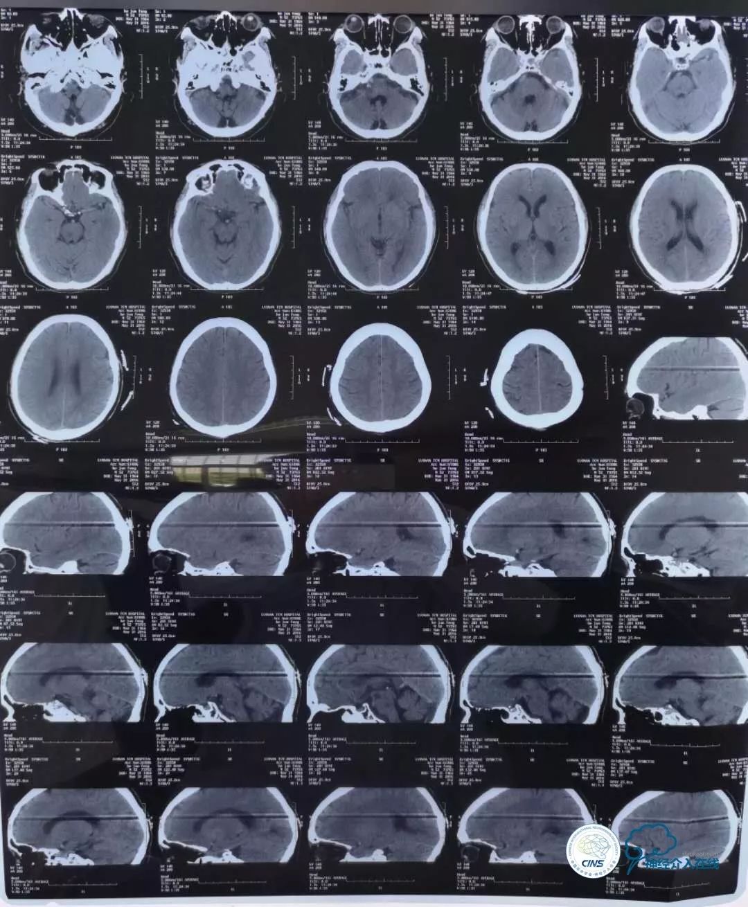 天新福—百家百言｜一例孤独椎动脉V4段并PICA重度狭窄支架手术及1年随访
