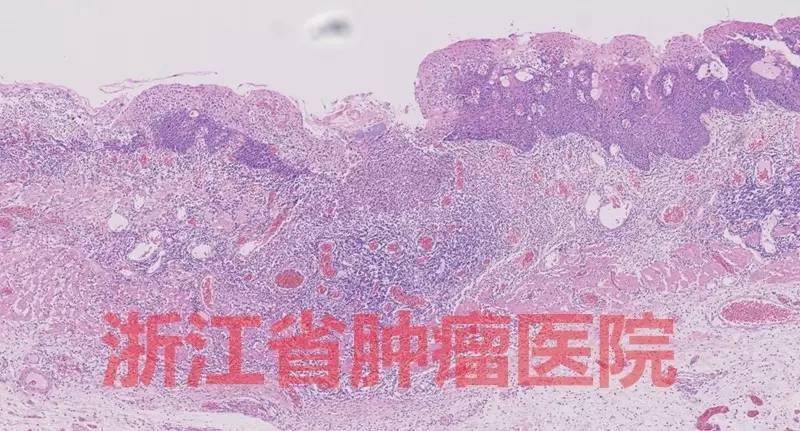 食管黏膜病变越大就一定是恶性吗,食管病变严重需要怎么治疗