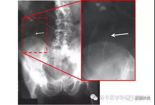 详细腹部平片解剖+正常表现+读片技巧+病例分析