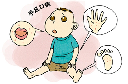 东莞手足口病,广东爆发手足口病