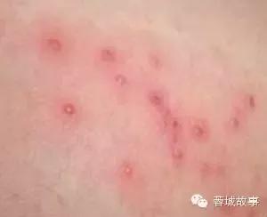 湿疹痒痒如何缓解,湿疹痒痒处能拍打么