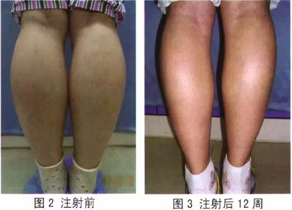 打了瘦腿针走路多影响效果吗,瘦腿针有没有效果有什么副作用