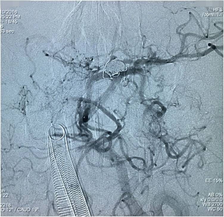 基底动脉顶端动脉瘤加左侧小脑上动脉瘤以Y型支架结合弹簧圈栓塞