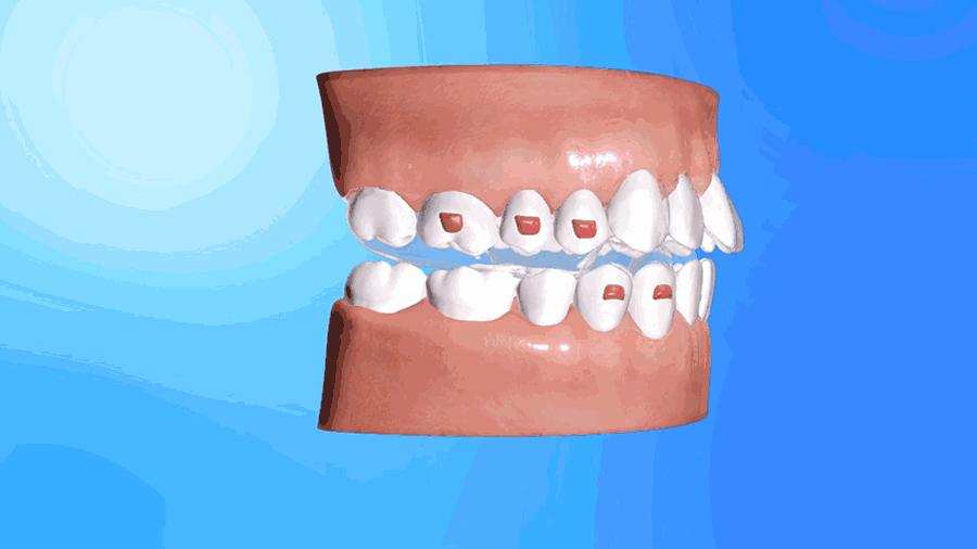 隐形矫正真的那么好吗？赵美牙带你破解隐形矫正五大谣言