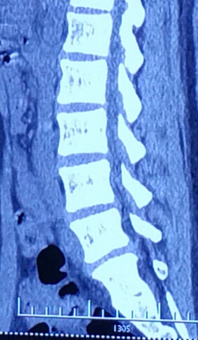 腰椎间盘突出怎么治疗好得快,女人腰椎间盘突出的亲身经历
