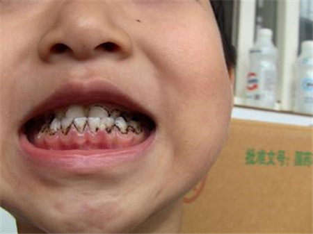 牙齿内侧根部发黑,牙齿内侧发黑是怎么回事