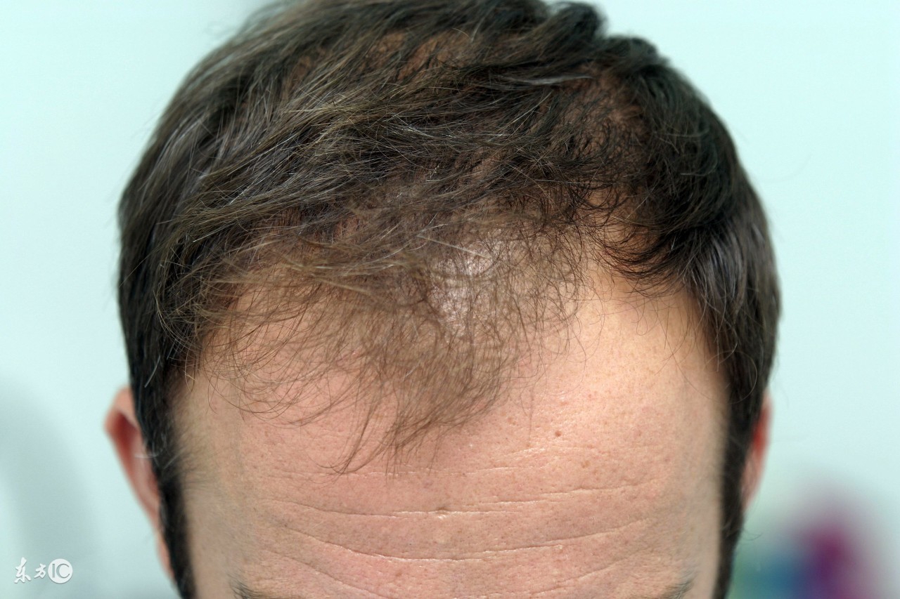 养发店能治脱发吗 (养发馆治疗白发脱发流程)