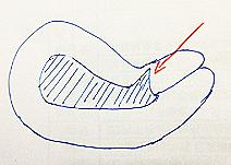 科普:什么叫子宫瘢痕憩(qi)室