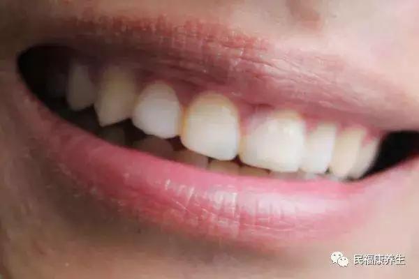 美白牙齿不伤牙齿的方法,牙齿黄咋办推荐五种美白方法