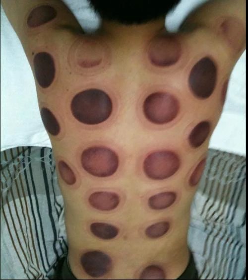 拔罐技巧视频教程全集,拔罐技巧怎么拔得更紧