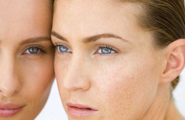 果酸换肤美白效果,果酸换肤和m22光子嫩肤哪个先做